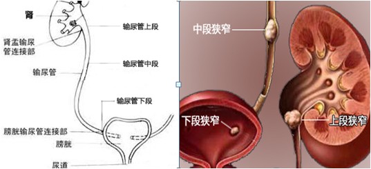 什么叫取石钳输尿管结石有什么症状?-上海聚慕医疗器械有限公司
