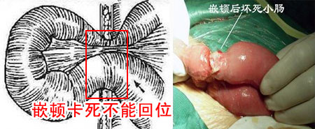 腹股沟疝气的4大危害不可小视